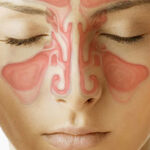 Información sobre la sinusitis