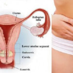 Síntomas del cáncer de útero
