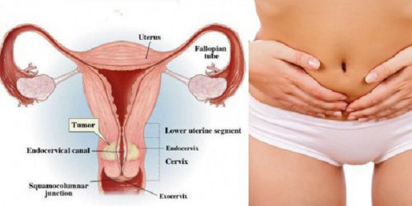 Síntomas del cáncer de útero