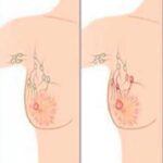 Causas del cáncer de mama y cómo prevenirlo