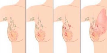 Causas del cáncer de mama y cómo prevenirlo