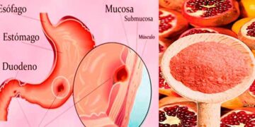 Cómo curar las úlceras de estómago