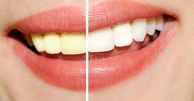Cómo blanquear los dientes con remedios caseros