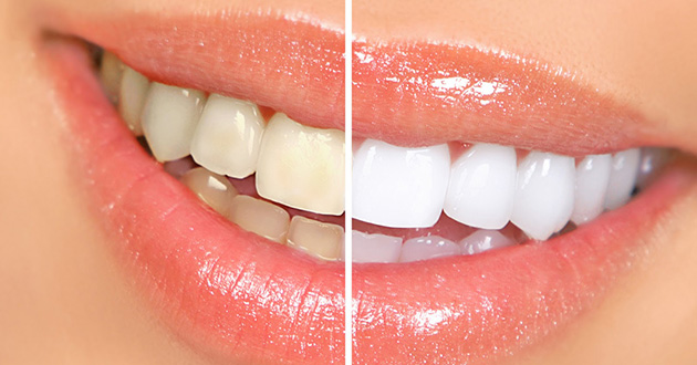 5 Remedios caseros para blanquear los dientes