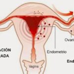 Todo sobre la endometriosis
