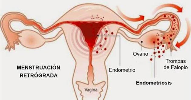 Todo sobre la endometriosis