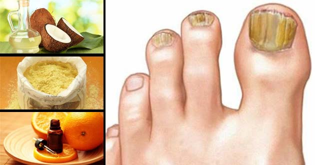 Cómo eliminar los hongos en las uñas de los pies