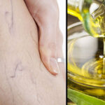 Cómo utilizar aceite de oliva para las varices