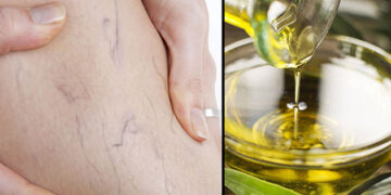 Cómo utilizar aceite de oliva para las varices