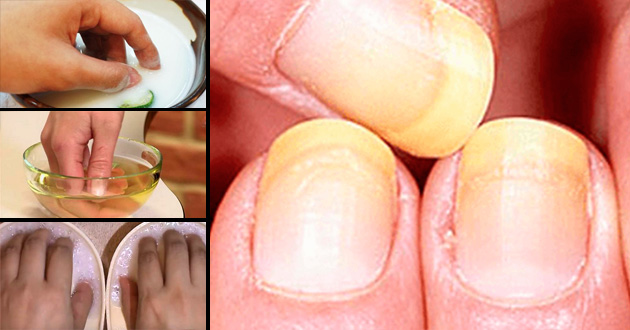 Cómo blanquear las uñas