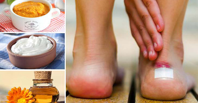 7 remedios naturales para aliviar las ampollas de los pies