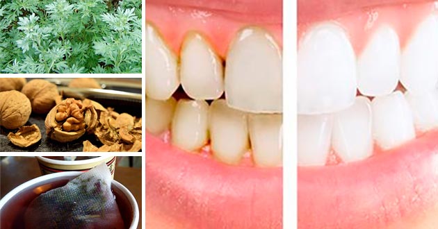 Remedios naturales para eliminar la placa dental