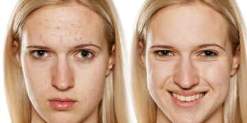 Cómo eliminar el acné naturalmente