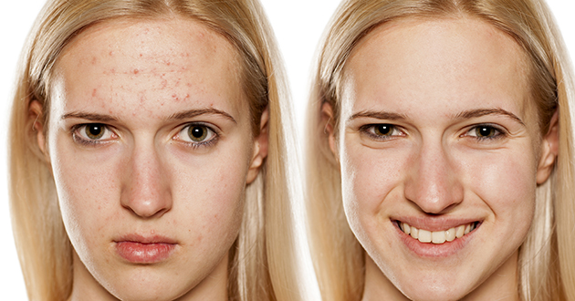 Cómo eliminar el acné de forma natural
