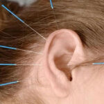 Adelgazar con la acupuntura en las orejas