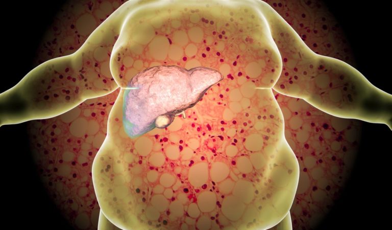Hígado graso: síntomas, tipos, causas y cómo tratarlo desde hoy mismo